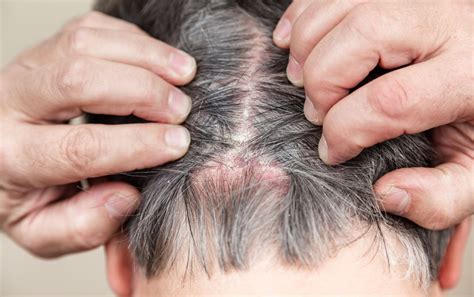 Scalp Psoriasis Diagnosis And Treatments