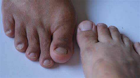 Most Common Tailor Bunion Surgery Complications Explained