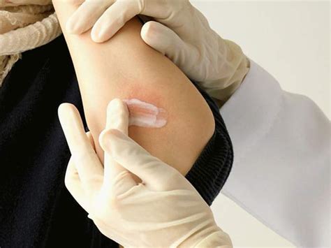Nummular Dermatitis Eczema Diagnosis And Treatments