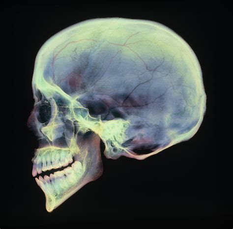 Human Skull X Ray Photograph By D Roberts
