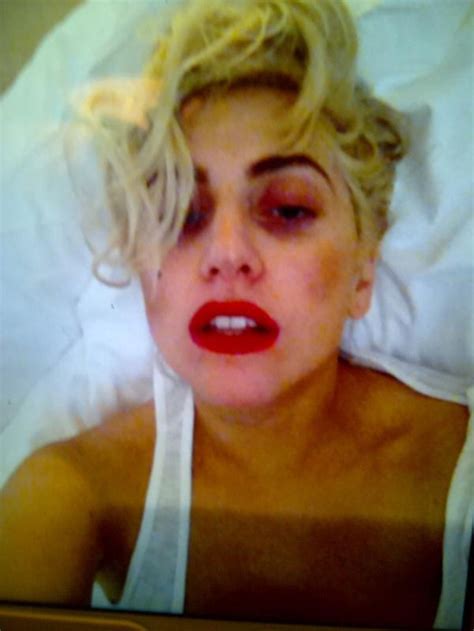 Lady Gaga Says She Still Feels Woozy After Getting Hit In The Head During Concert