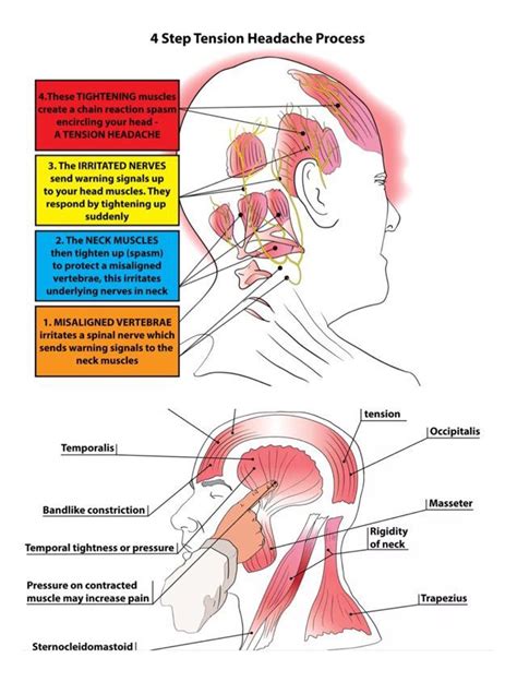 Treating Tension Headaches Trigger Point Therapy Tension Type Headache Tension Headache