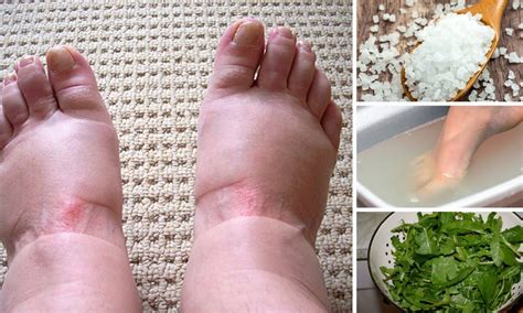 Home Remedies For Swollen Feet