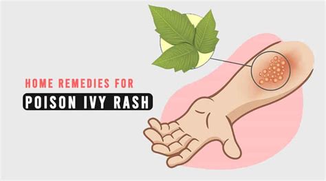 Top 10 Home Remedies For Poison Ivy Rash Healthtostyle