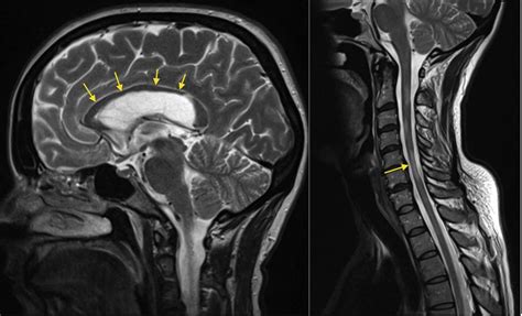 Multiple Sclerosis Spinal Cord Atrophy Radiology At St Vincents
