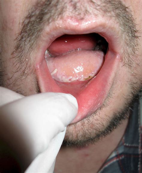 Rak jamy ustnej jak wygląda Objawy i rokowania Hot Sex Picture