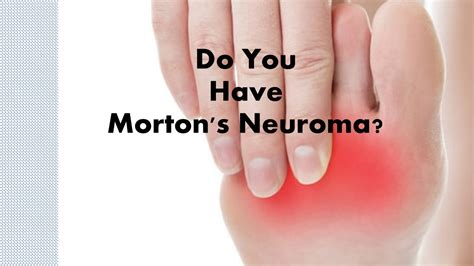 Ball Of Foot Sore You May Have Mortons Neuroma Total Care Podiatry