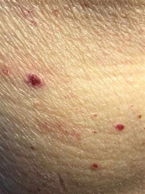 Small Red Papules Clinical Advisor