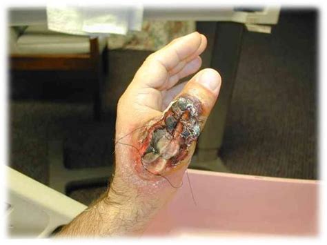 Symptoms of a reaction to the venom start about 30 minutes after the bite. Lesson 3 Derm UF PA Flashcards | Easy Notecards