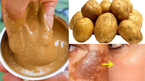 How To Use Potato For Pigmentation Removal Potato For Skin Lightening