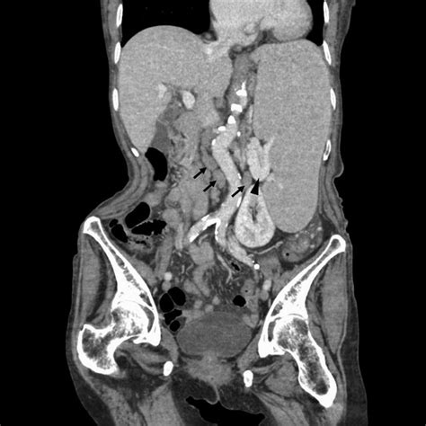 Abdominal Contrast‐enhanced Computed Tomography Findings Abdominal
