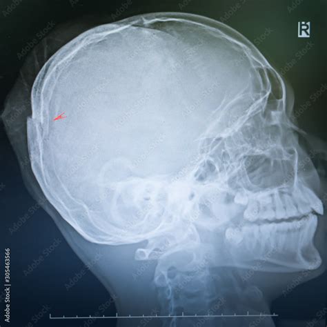 Fractured Skull X Ray