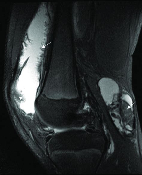 Sagittal Proton Density Mri Of The Knee Showing Large Joint Effusion Download Scientific