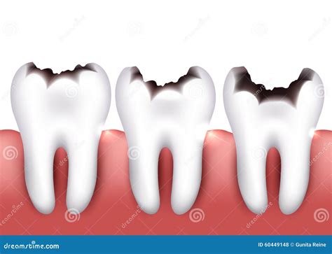 Dental Caries Stages Vector Medical Poster Banner Template