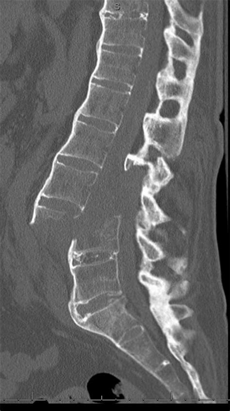 Neurologically Intact Lumbar Spine Displaced Fracture With Ankylosing
