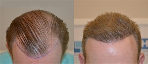 Get the best price for a hiv test with mdsave. How Much Does Hair Transplant Cost? - DHI International