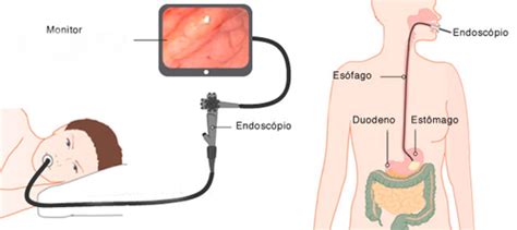 Endoscopia Digestiva Alta Doctor Fernando Mejia