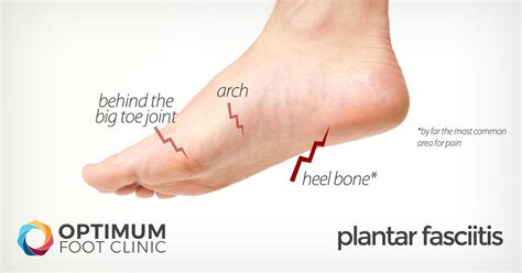 Plantar Fasciitis Heel Pain Explained Optimum Foot Clinic Expert Custom Lower Limb Orthotics