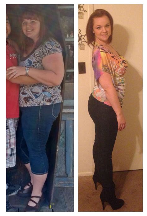 Pin On Before And After Gastric Sleeve