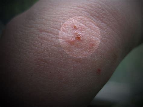Eczema On Elbows Pictures Photos