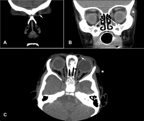 An Unusual Case Of Unilateral Multiple Periorbital Dermoid Cyst