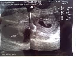 Janin yang terlihat tersebut masih berupa titik janin saat usia kehamilan masih 5 minggu. PENTING !!! Membaca Foto di USG | 8 Trending News