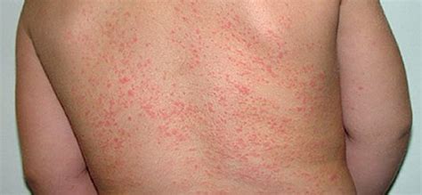 Prickly Heat Symptoms Causes Prognosis Treatment Prickly Heat