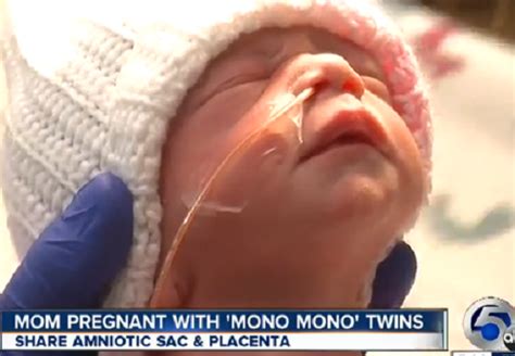 best mother s day present rare mono mono twins born holding hands