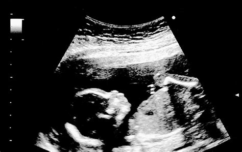 18 Weeks Pregnant Symptoms Ultrasound And Fetus Development