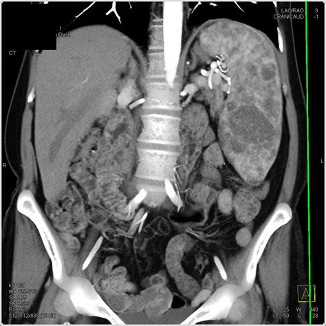 Sarcoidosis Of The Spleen In A Patient With Cirrhosis And Portal
