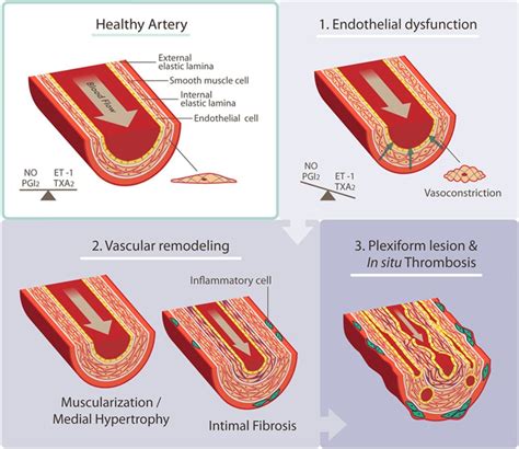 Pulmonary Arterial Hypertension Circulation Research