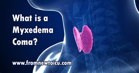 What Is A Myxedema Coma — From New To Icu