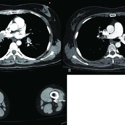 Contrast Enhanced Computed Tomography At Initial Visit A B
