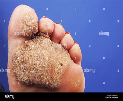 Plantar Warts High Resolution Stock Photography And Images Alamy