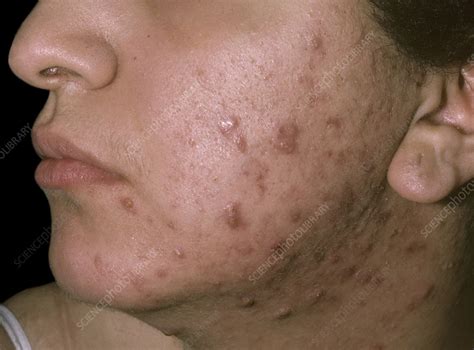 Acne On The Face And Neck Stock Image C0459527 Science Photo Library