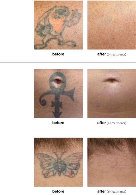 Share About Laser Tattoo Removal After Sessions Unmissable In Daotaonec