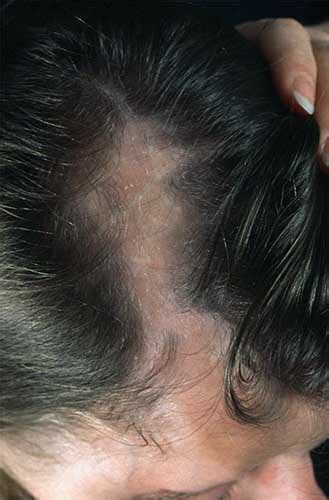 Apart from medications, there are other things you can try if you have. Alopecia cicatrizal, también llamada cicatricial, causas y ...