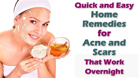 Acne Home Remedy Fast And Best Natural Methods To Get Rid Of Your