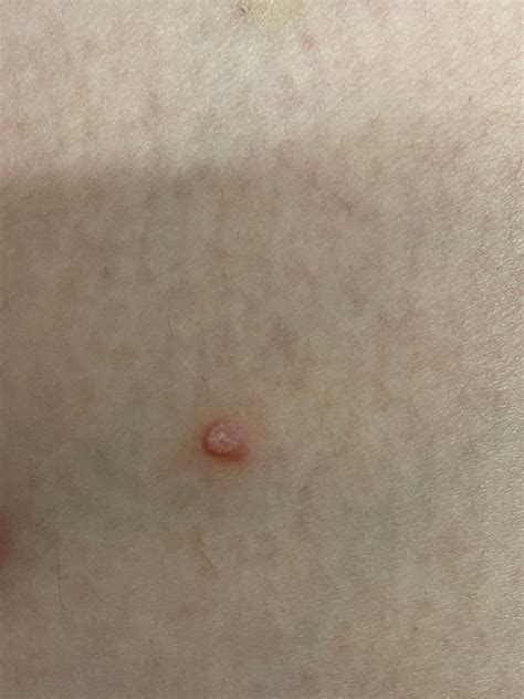 Ive Had This Pimple Like Wart Looking Thing On My Thigh Its