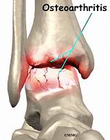 Loose Ligaments In Ankle Treatment