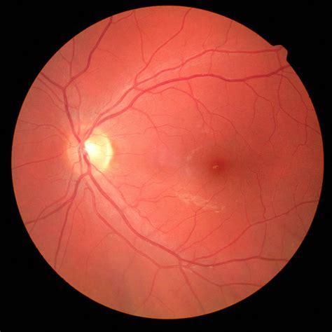 Digital Retinal Eye Imaging Advanced Eye Care Isee Optical