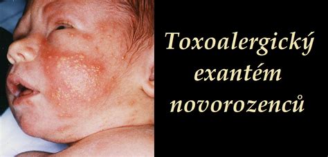 Toxoalergický Exantém Novorozenců Příznaky Projevy Symptomy