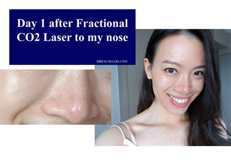 Dr Rachel Ho How To Get Rid Of Large Pores Myths And Truths