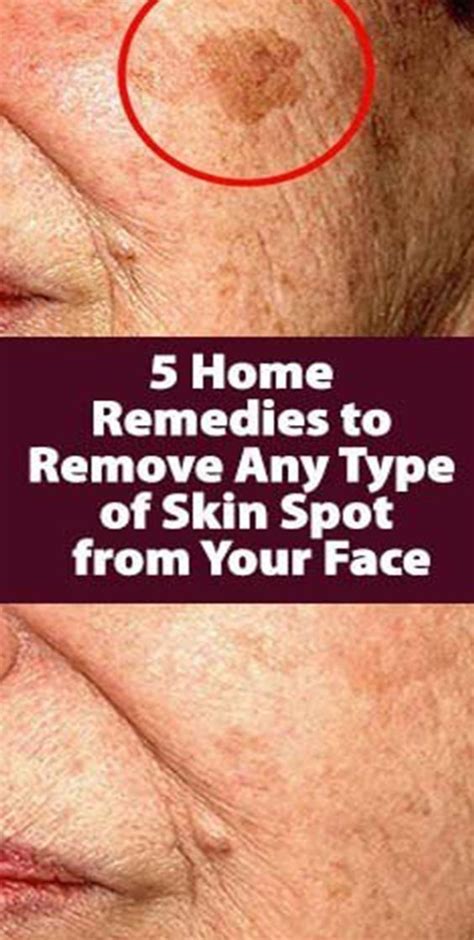 Simple Trick To Remove Brown Spots From Your Skin Spots On Face Skin