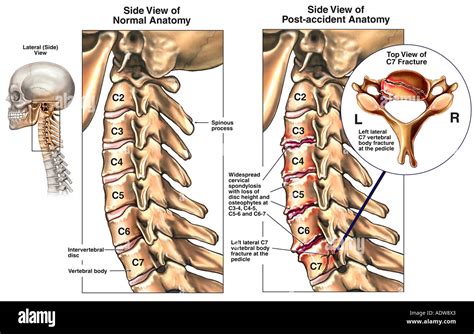 Puesto Condición De Accidente Con Espondilosis Osteophytes Y La