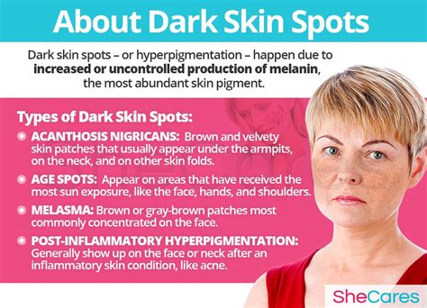 Dark Skin Spots Shecares