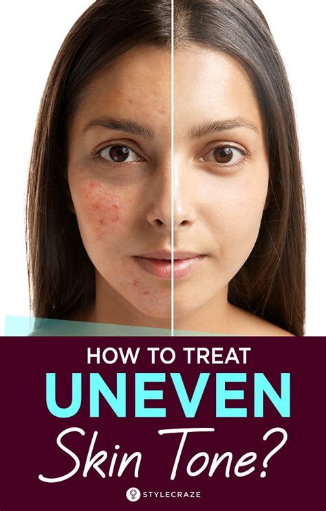 Uneven Skin Tone Tips To Get Rid Of It Naturally Uneven