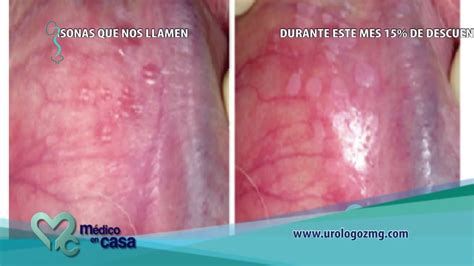 Dr Oscar Maga A Urologozmg Infecci N Por Virus Del Papiloma Humano
