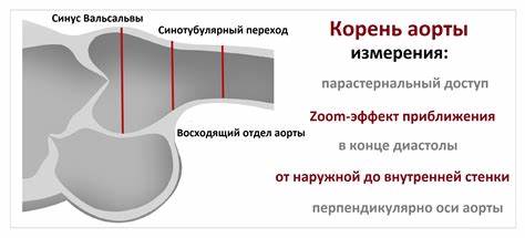 Корень аорты на ЭхоКГ (АоКл2) - Диагностер Картинка - Корень аорты на ЭхоКГ (АоКл2) - Диагностер