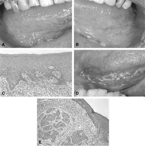 The Possible Premalignant Character Of Oral Lichen Planus And Oral